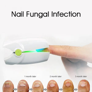 Rechargeable Nail Fungus Removal Laser Treatment Device -  Highly Effective